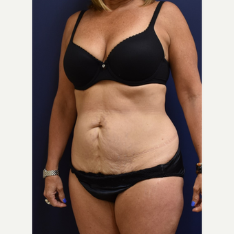 45-54 year old woman treated with Tummy Tuck before 3744538