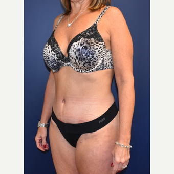 45-54 year old woman treated with Tummy Tuck after 3744538