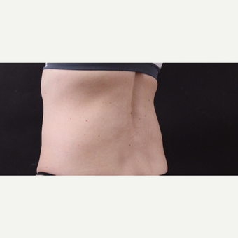49 year old woman treated with CoolSculpting before 3630246