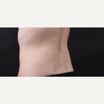 49 year old woman treated with CoolSculpting after 3630246