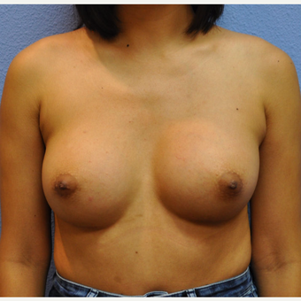 18-24 year old woman treated with Breast Augmentation after 3105215