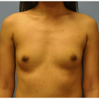 18-24 year old woman treated with Breast Augmentation before 3105215