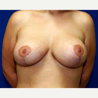 25-34 year old woman treated with Breast Lift after 3037720
