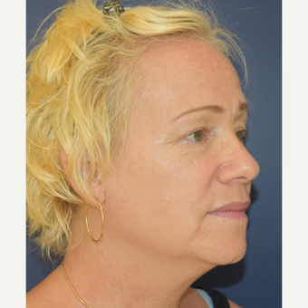 55-64 year old woman treated with Neck Lift before 3504041