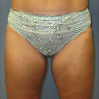 45-54 year old woman treated with CoolSculpting after 3764019