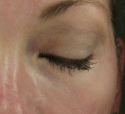 Tear Trough after injection with Restylane after 52897