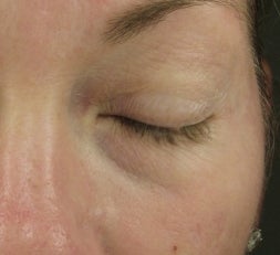 Tear Trough after injection with Restylane before 52897