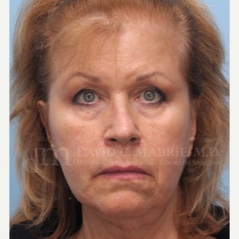 Under Eye Treatment before 1842915