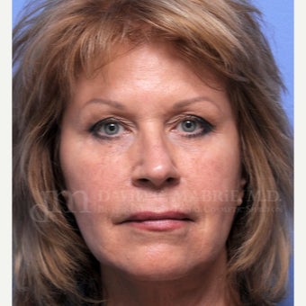Under Eye Treatment after 1842915