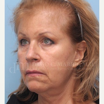 Under Eye Treatment 1842915