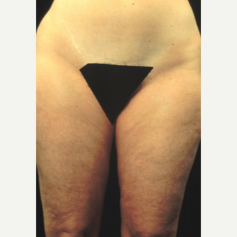 45-54 year old woman treated with Liposuction before 2951172