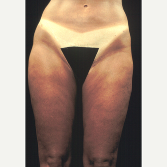 45-54 year old woman treated with Liposuction after 2951172