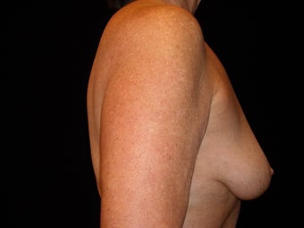 60 year old lady treated for breast atrophy with fat transfer before 631682