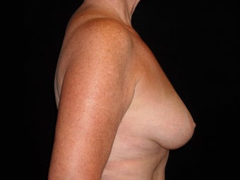 60 year old lady treated for breast atrophy with fat transfer after 631682