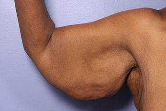 45-54 year old woman treated with Arm Lift before 1679031