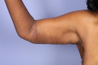 45-54 year old woman treated with Arm Lift after 1679031