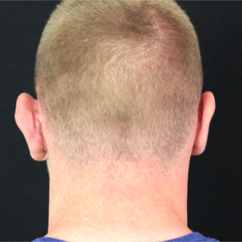 18-24 year old man treated with Ear Surgery before 3020601