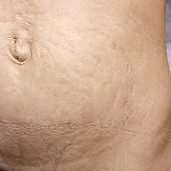 37 year old woman, stretch mark treatment with RecoSMA before 3499293