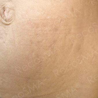37 year old woman, stretch mark treatment with RecoSMA after 3499293
