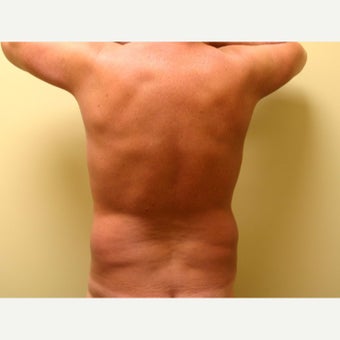 45-54 year old man treated with Vaser Liposuction before 2083554