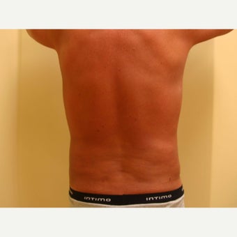 45-54 year old man treated with Vaser Liposuction after 2083554