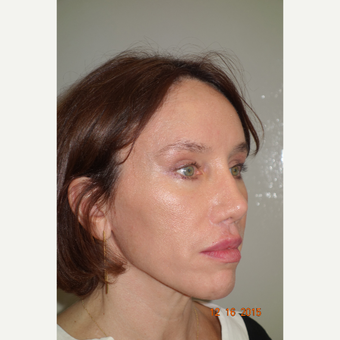 45-54 year old woman treated with Brow Lift after 3649082