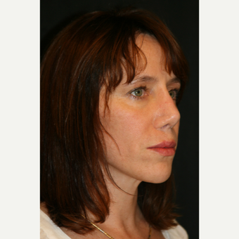 45-54 year old woman treated with Brow Lift before 3649082