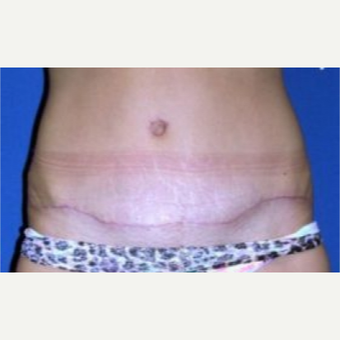 35-44 year old woman treated with Tummy Tuck after 3009826