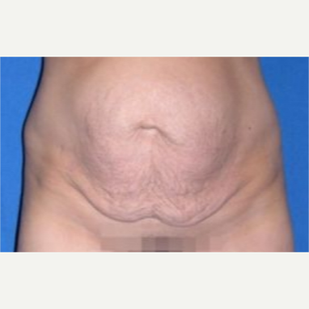 35-44 year old woman treated with Tummy Tuck before 3009826