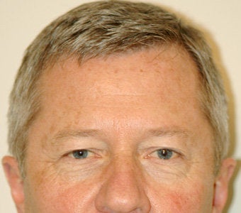 Before and After Endobrow and Quad Bleph in Male Patient before 65328
