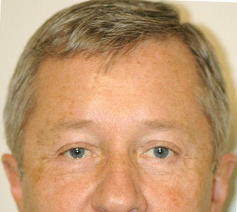 Before and After Endobrow and Quad Bleph in Male Patient after 65328