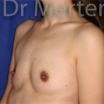 18-24 year old woman treated with Breast Augmentation before 3552619