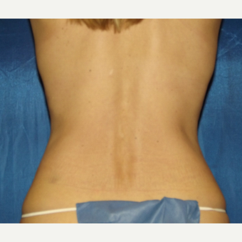 52 year old woman's flanks treated with 1 SculpSure treatment after 2814914