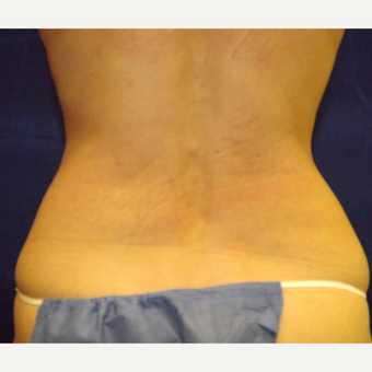 52 year old woman's flanks treated with 1 SculpSure treatment before 2814914
