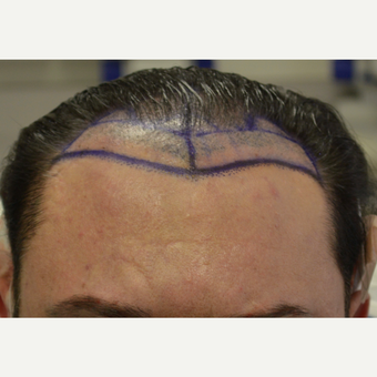 35-44 year old man treated with FUE Hair Transplant before 3667216