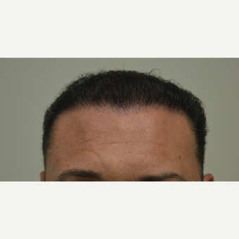 35-44 year old man treated with FUE Hair Transplant after 3667216