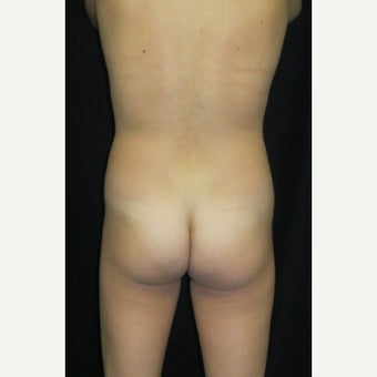 25-34 year old woman treated with Fat Transfer to the Buttock (Brazilian Butt Lift) before 1641849