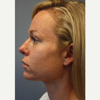 25-34 year old woman treated with Fraxel Laser before 3709226