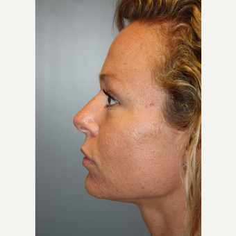 25-34 year old woman treated with Fraxel Laser after 3709226