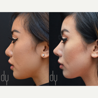 Asian Rhinoplasty with Rib cartilage before 3739410