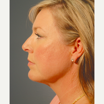 35-44 year old woman treated with Kybella after 3376456