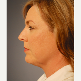 35-44 year old woman treated with Kybella before 3376456