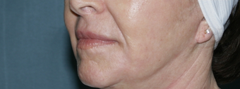 Face and neck Fraxel repair with C02/Erbium lasers for upper lip wrinkles after 104644