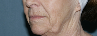 Face and neck Fraxel repair with C02/Erbium lasers for upper lip wrinkles before 104644