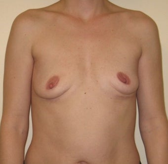 25-34 year old woman treated with Breast Implant Removal after 1606659