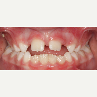 17 or under year old woman treated with Braces before 3188465