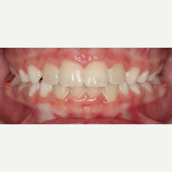 17 or under year old woman treated with Braces after 3188465