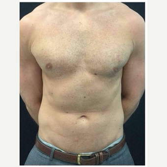 25-34 year old man treated with Male Breast Reduction after 3185980