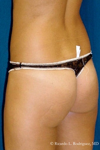 Brazilian Butt Lift before 635023