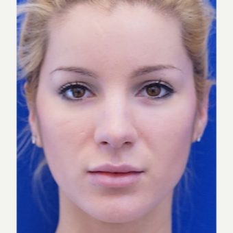18-24 year old woman treated with Lip Augmentation after 3716253